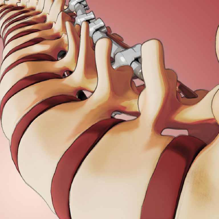 Spinal Fusion Surgery