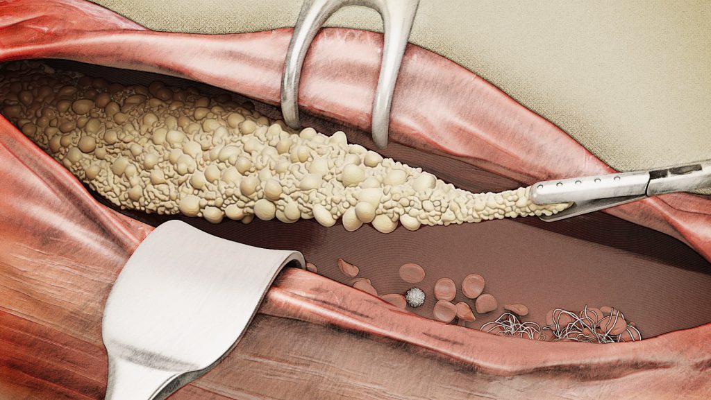 Atherosclerosis 3D (stylized)