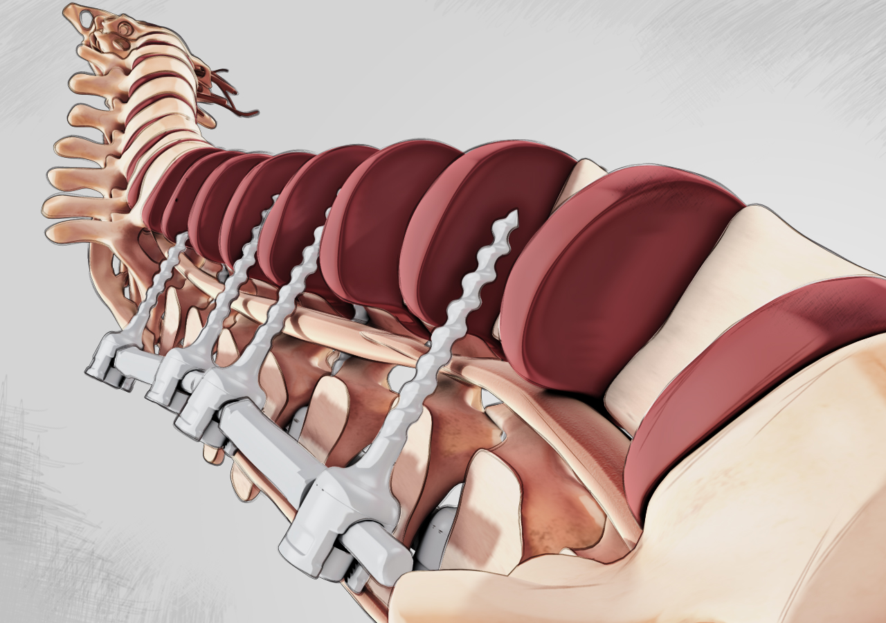 Spinal Fusion Surgery