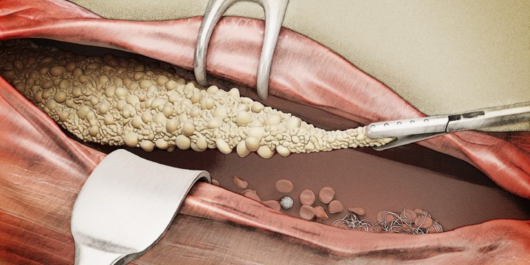 Atherosclerosis Illustration